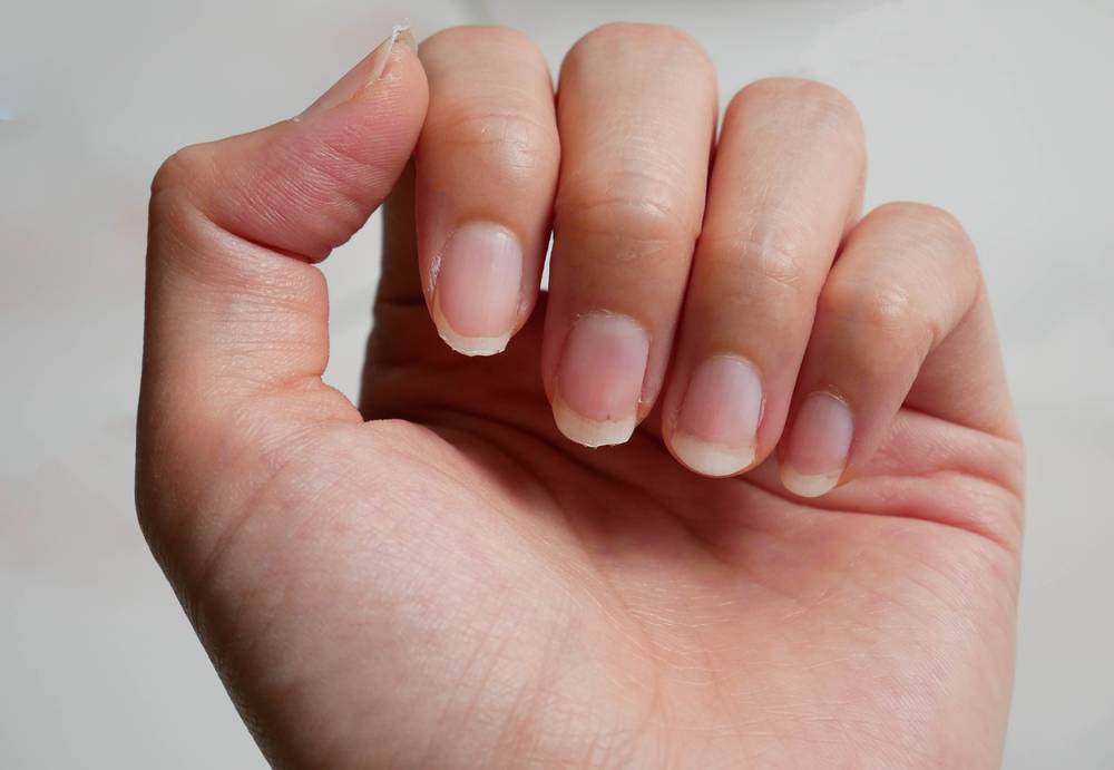 Cлоятся и ломаются ногти на руках: что делать, причины и лечение в домашних условиях