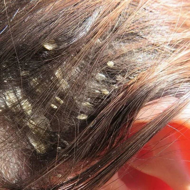 Псориаз волосистой части головы: причины возникновения и способы лечения | портал 1nep.ru