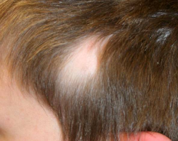Выпадают волосы у ребенка: причины и лечение заболевания, норма и патология