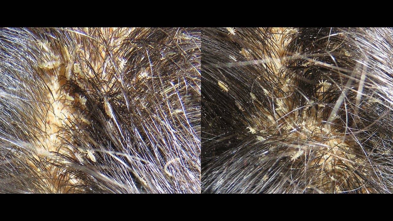 Как отличить перхоть от гнид на волосах – методы, позволяющие не путать гнид с перхотью