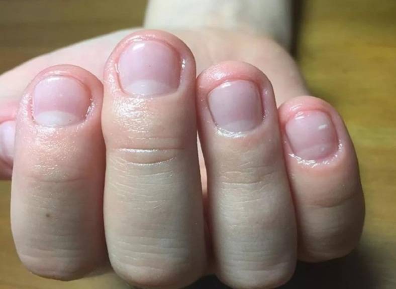 Почему взрослый человек грызет ногти на руках: причины, как избавиться от привычки в домашних условиях