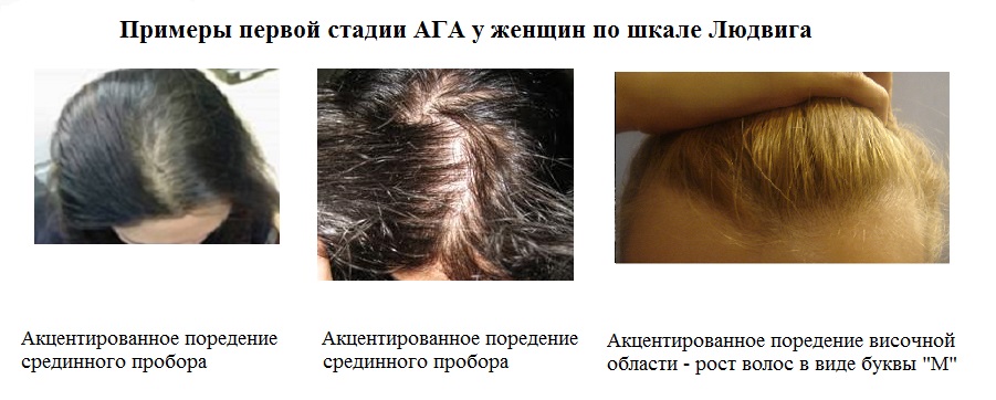 Причины выпадения волос - методы лечения, правильный уход -клиника "отражение"
