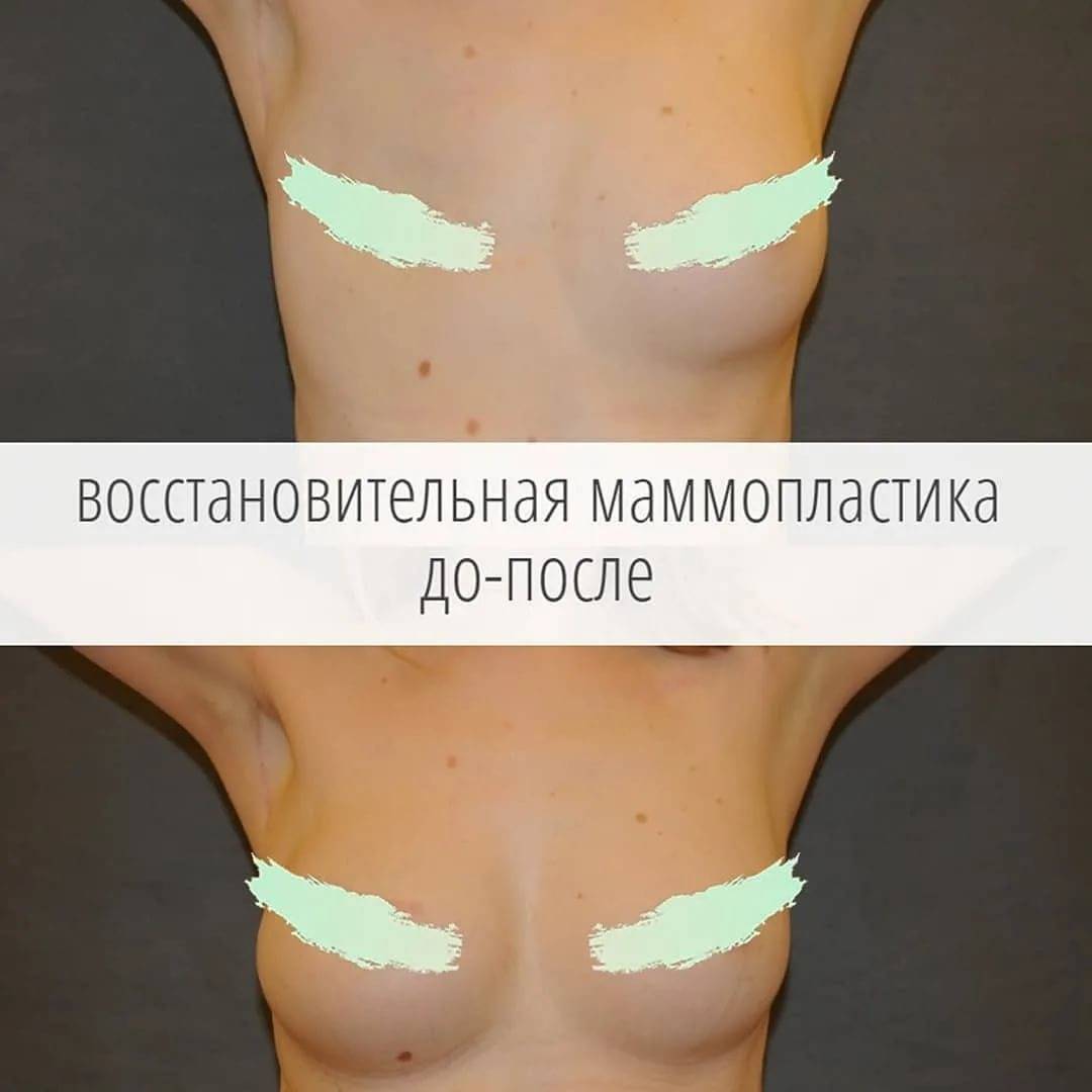 Увеличение груди: плюсы и минусы | александр маркушин пластический хирург