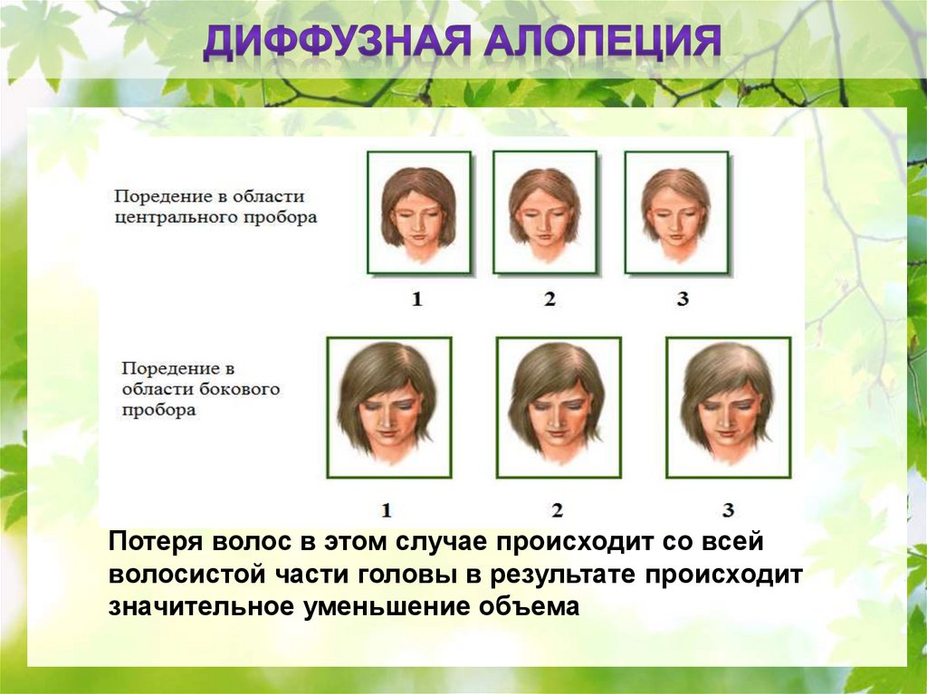 Диффузное выпадение волос у женщин: причины, лечение, профилактика