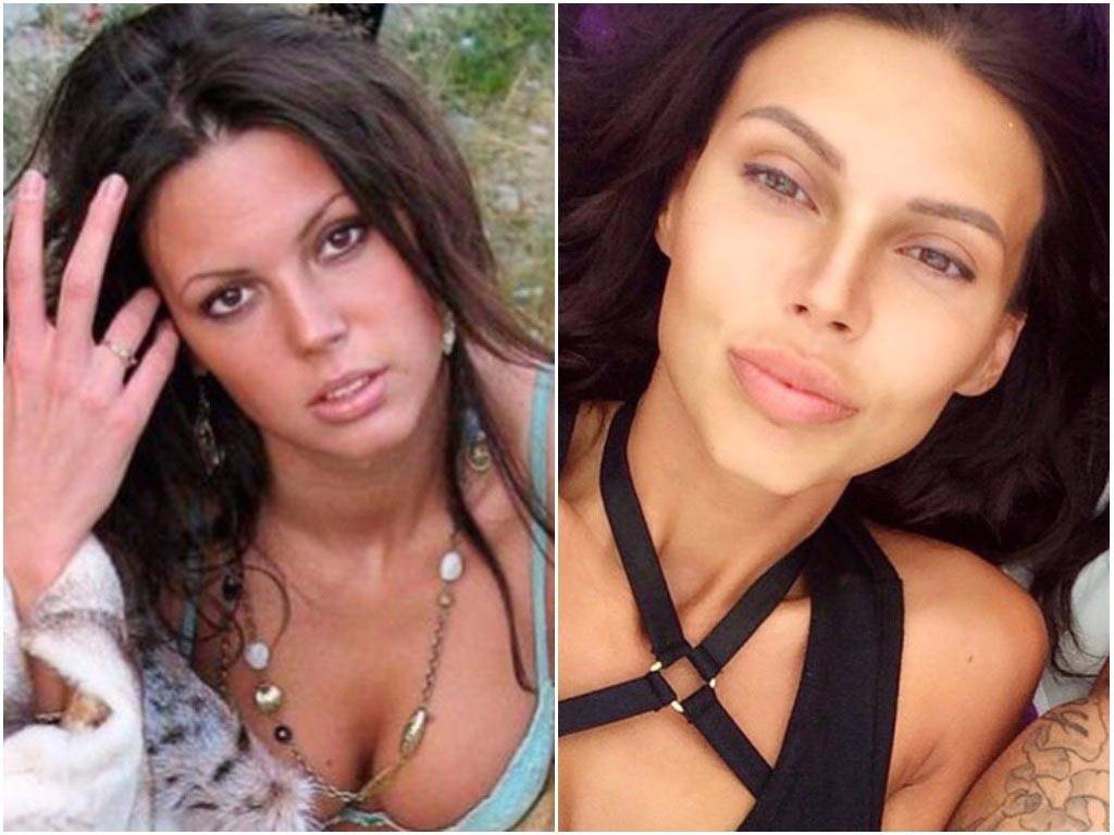 Оксана самойлова до и после пластики: фото до операции, как выглядела раньше