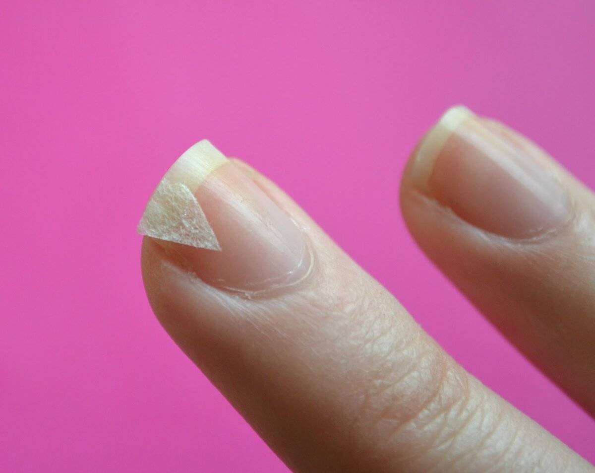Слоятся ногти: почему ломаются на руках, чего не хватает в организме, каковы причины отслоения, что делать для лечения?