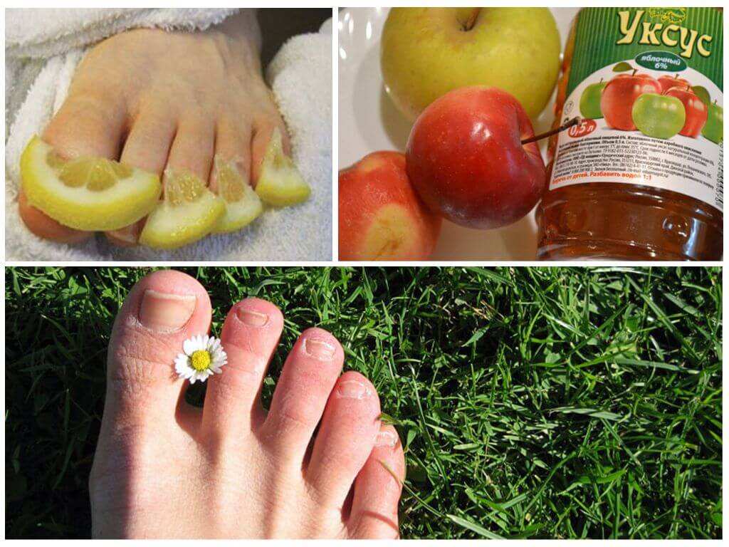 Грибок ногтей: лечение, запущенная форма, симптомы, признаки, средство от грибка ногтей. как выглядит грибок на ногах - форма