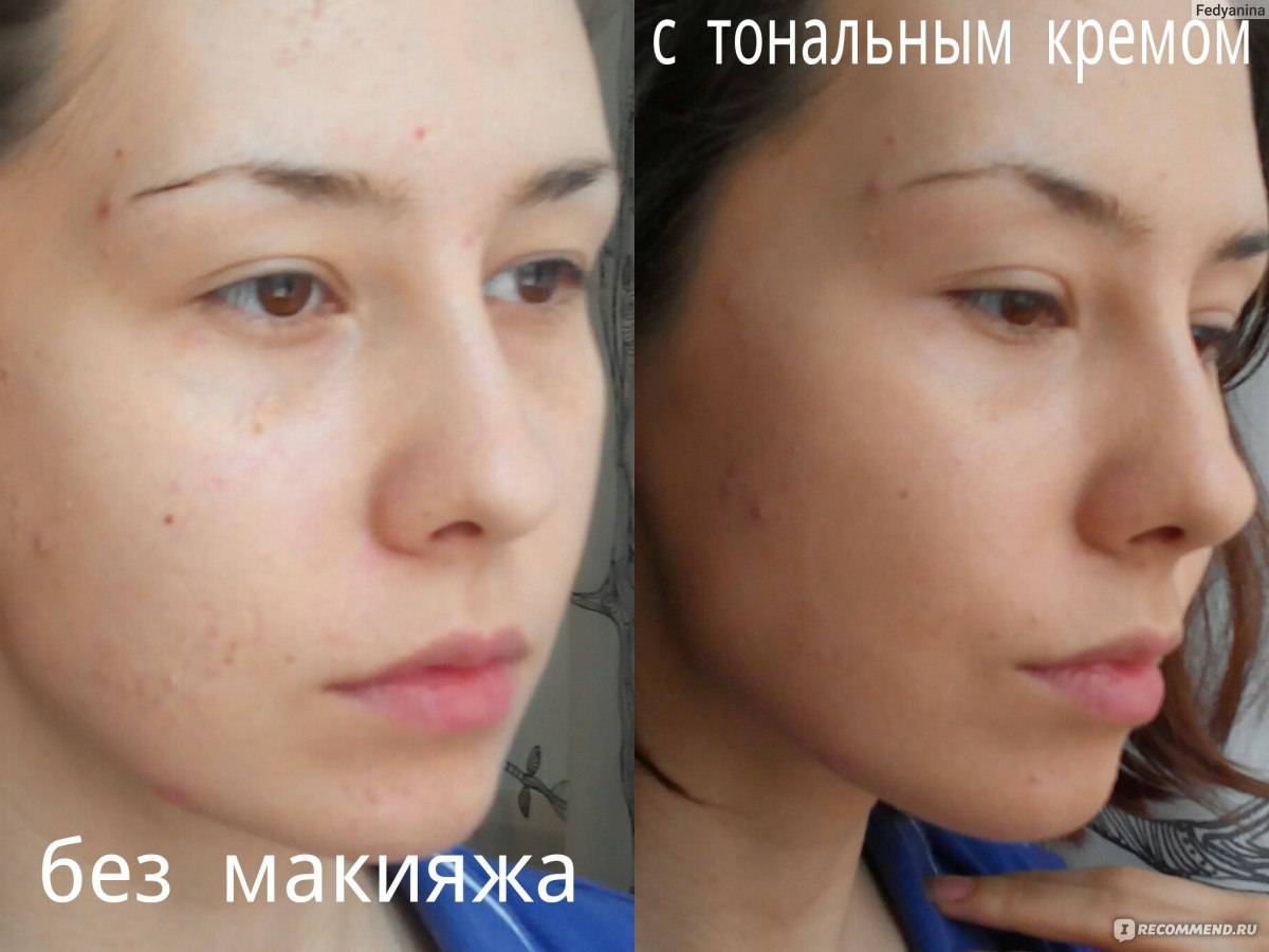 Что такое meso bb glow ideal face skin treatment в косметологии или как быть красивой?