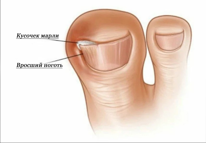 Болит большой палец на ноге | сеть клиник «здравствуй!»