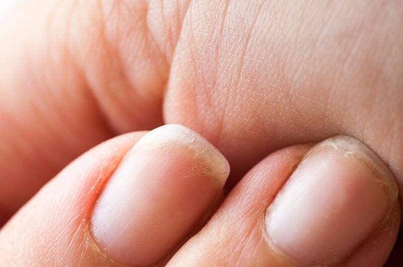 Ногти слоятся сухая кожа. Ногти слоятся что делать в домашних условиях