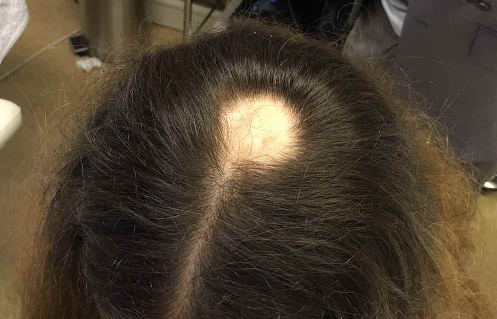 Очаговое облысение у женщин, причины очагового выпадения волос у женщин