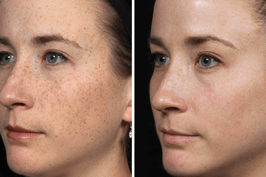 Пятен удалить лица. Пигментация на лице до и после. Лазерный пилинг для лица от пигментных пятен. Фотолечение пигментации лица. Фотоомоложение пигментация.