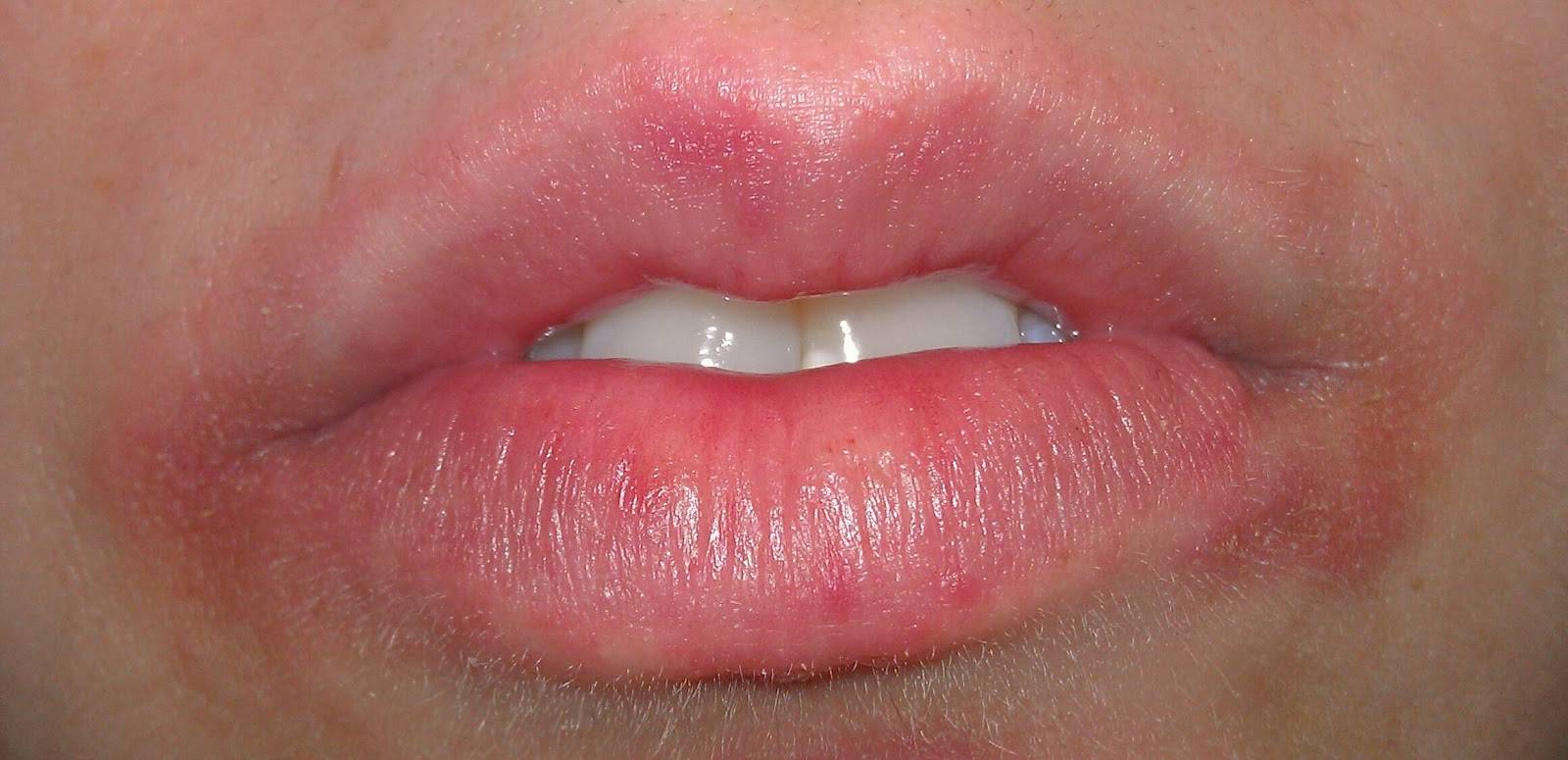 Как убрать кисетные морщины вокруг губ - 7 эффективных способов устранения морщин вокруг рта | клиника "отражение"