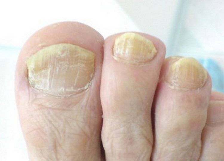 Псориаз ногтей: фото повреждений ногтей при псориазе