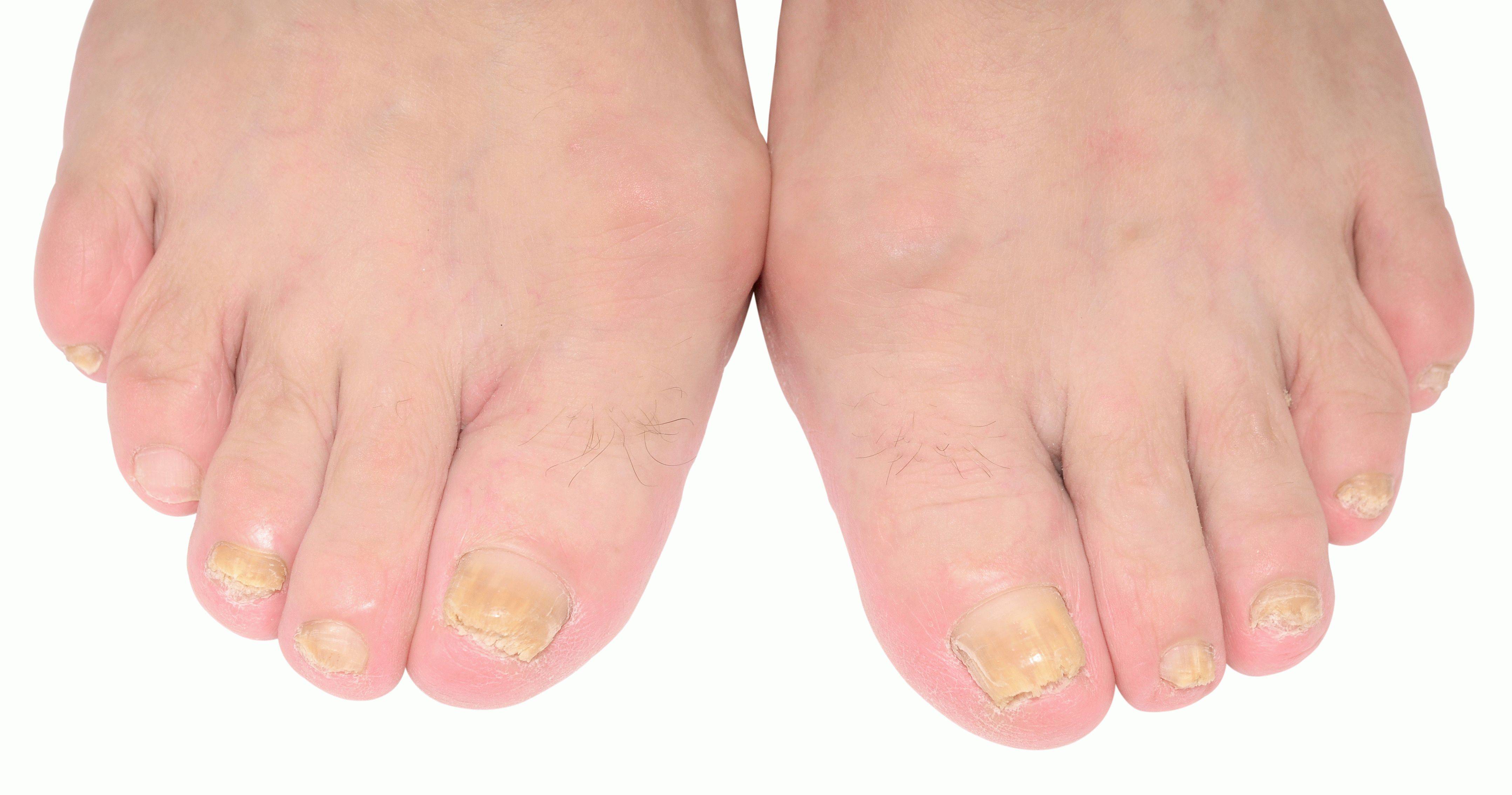 Симптомы грибка ногтей на ногах: какие первые признаки, виды и причины онихомикоза