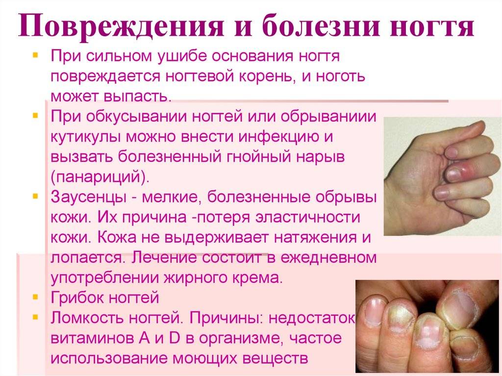 Диагностика по ногтям: как определить заболевание по ногтевой пластине