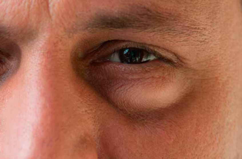 Отечность глаз: причины | дельфанто