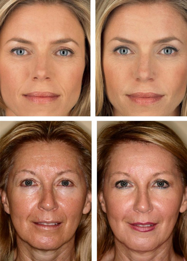 Биоревитализация гиалуроновой кислотой, лазерная биоревитализация - омоложение кожи лица, фото до и после