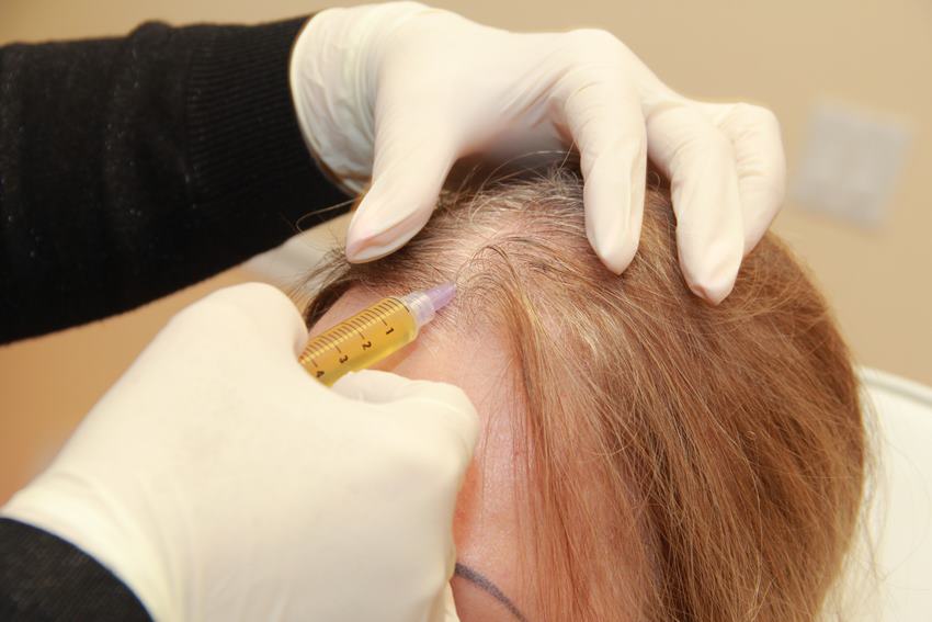 Причины выпадения волос — медицинский центр «целитель»