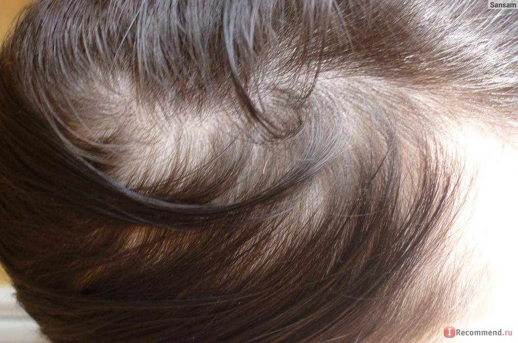 Выпадение волос во время и после беременности — норма ли это?