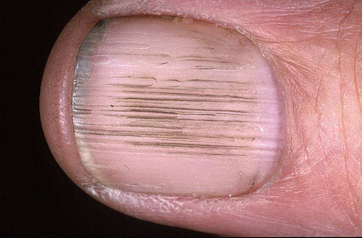 Полоски на ногтях причины вертикальные у женщин. Продольная меланонихия. Поперечные борозды бо Рейля. Подногтевая гранулема.