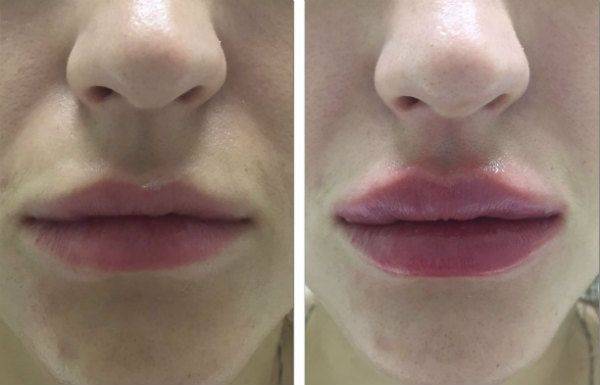 Каким должен быть уход за губами после инъекций гиалуроновой кислоты?