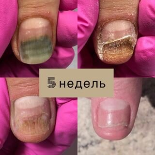 Болезни и проблемы ногтей