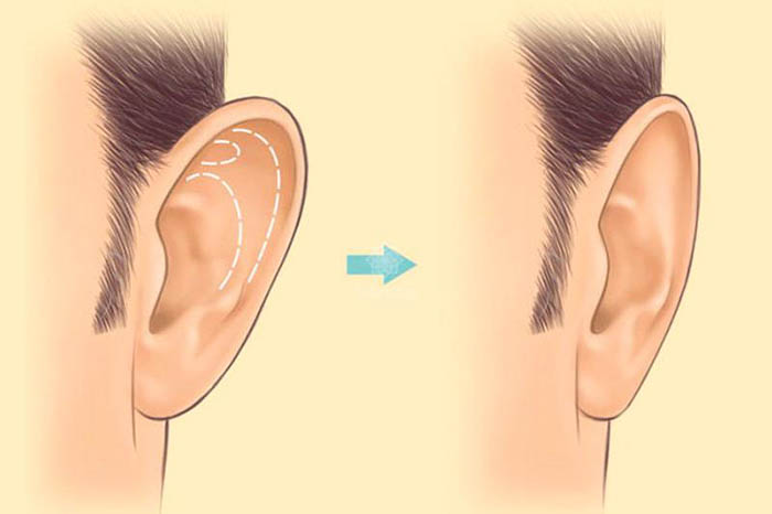 Коррекция ушей