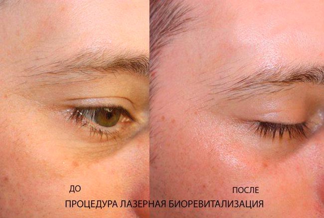 Безинъекционная биоревитализация: что это такое и, как проводится процедура