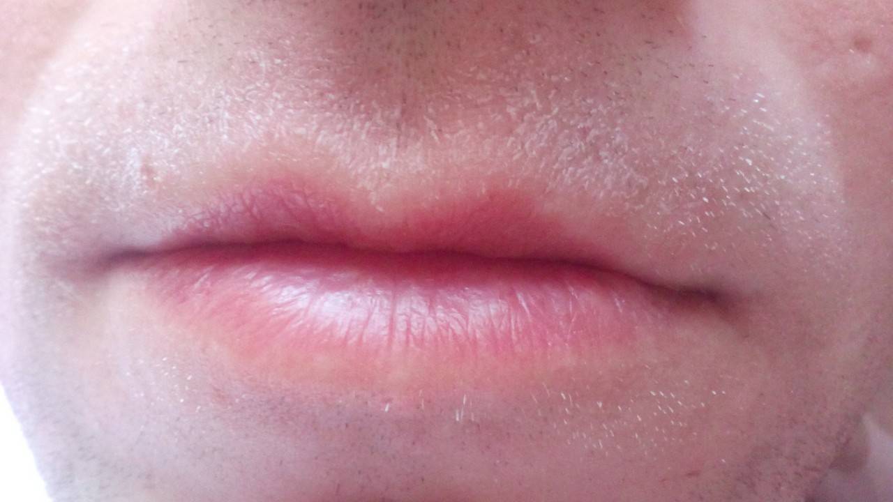 Как убрать морщины вокруг губ: способы избавиться от кисетных морщин в домашних услових, с помощью косметологии и пластической хирургии