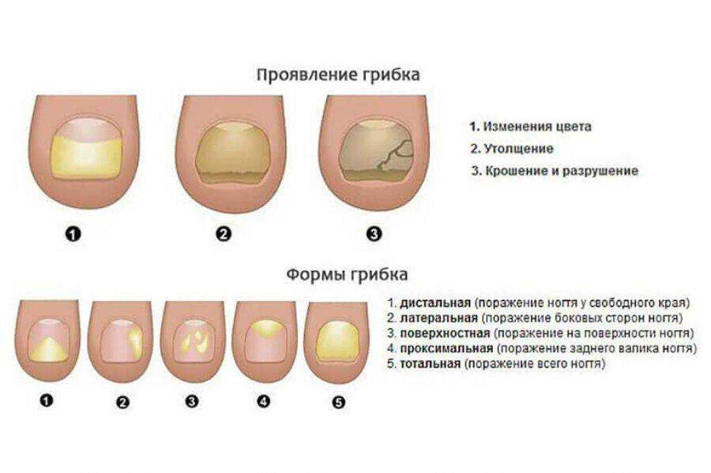 Что такое грибок ногтей? источники и причины инфекции