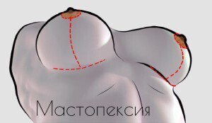 Якорная подтяжка груди