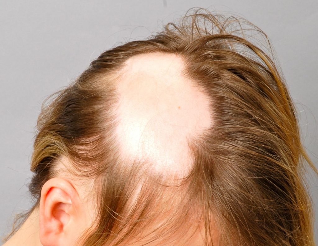 Чем лечить очаговую алопецию у мужчин на голове
