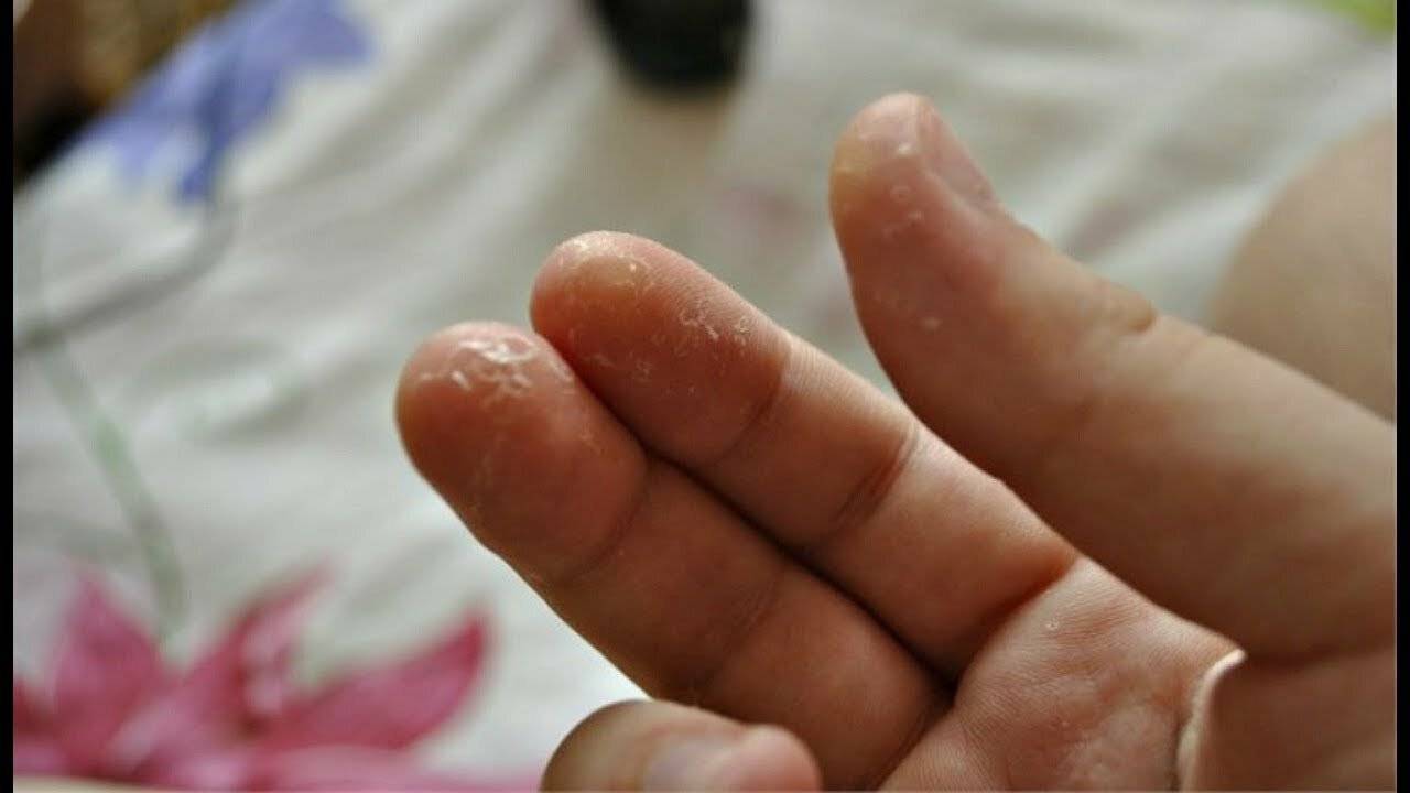 Феномен рейно: почему белеют пальцы