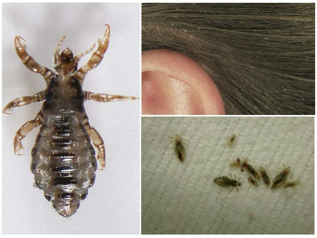 К чему снится что в волосах много насекомых