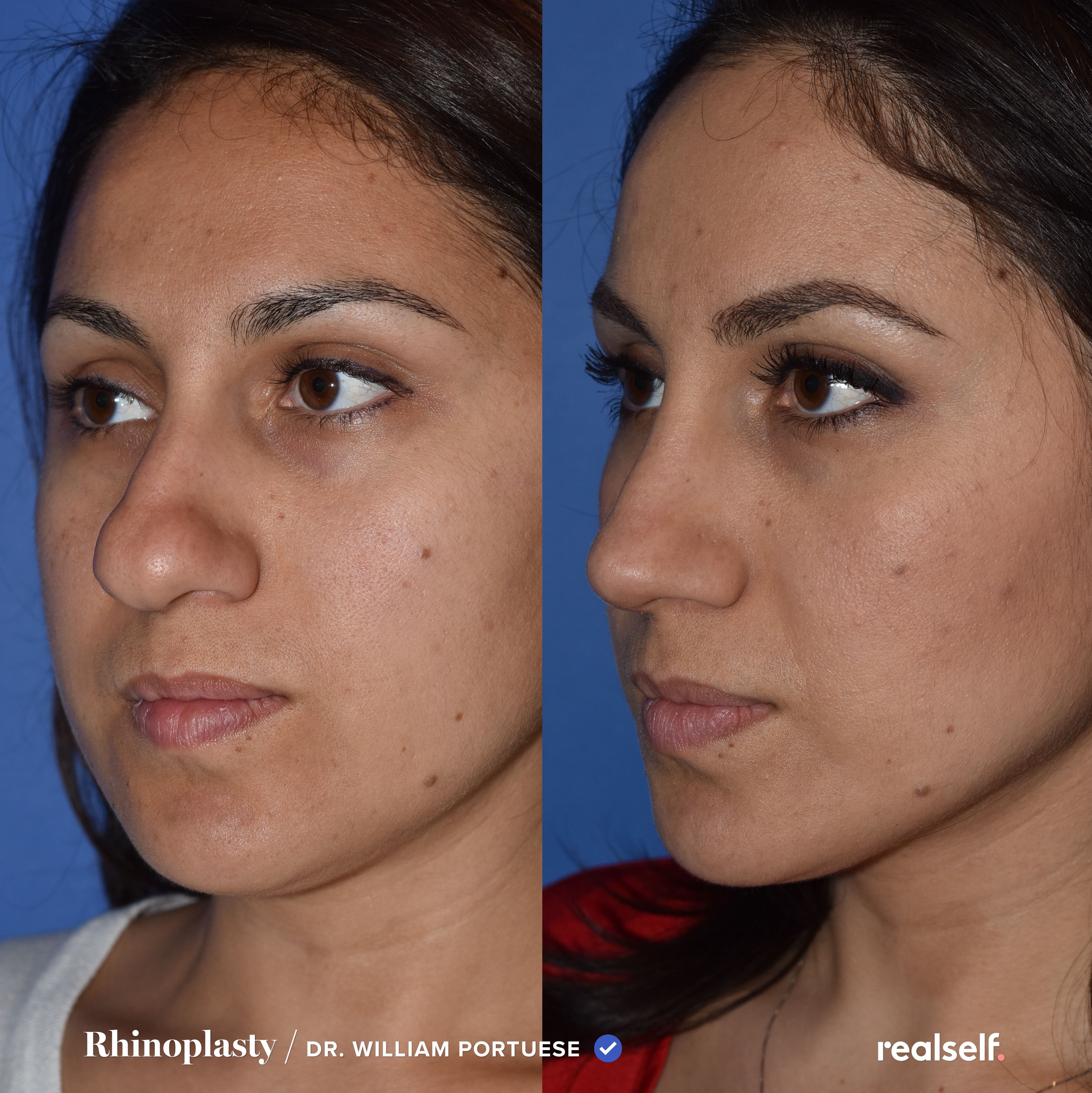 Как исправить курносый нос: фото до и после ринопластики, показания и противопоказания