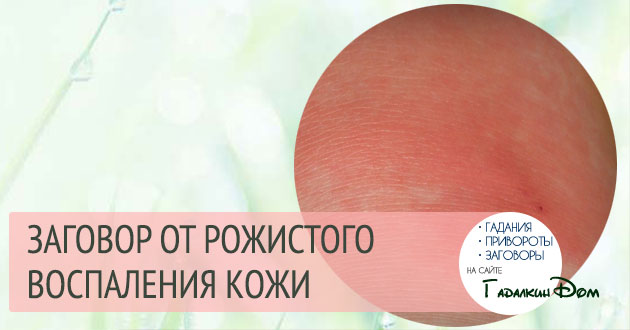 Диагностика, лечение и профилактика рожи. лечение рожистого воспаления на ноге. фото