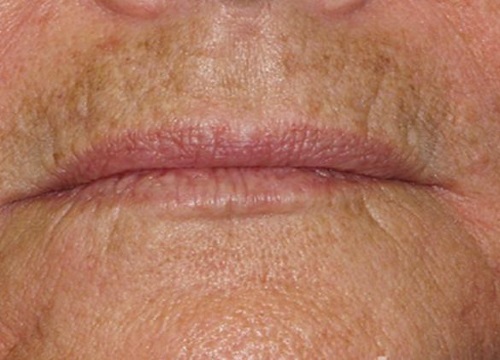 Морщины над верхней губой - как убрать | избавиться от морщин над губами - способы, причины, профилактика