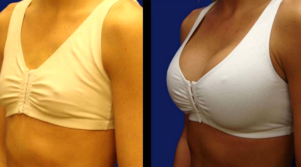 Швы после подтяжки груди: фото до и после, реабилитация | институт красоты галактика