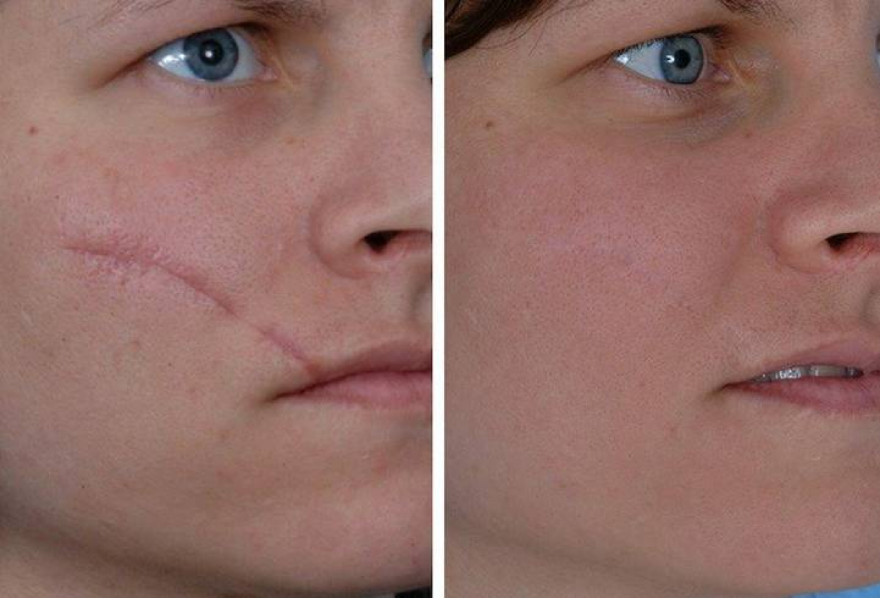 Лазерная шлифовка (дермабразия) кожи лица, рубцов, шрамов, растяжек