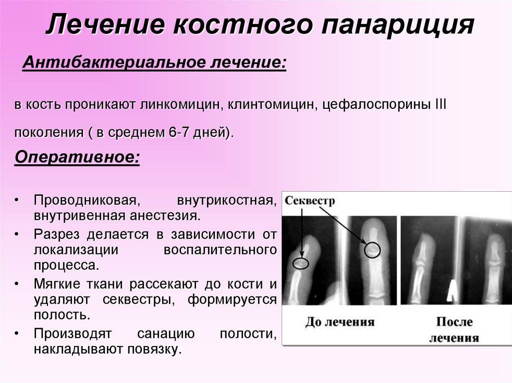 Паронихия пальца - причины и лечение | отделение платных мед услуг