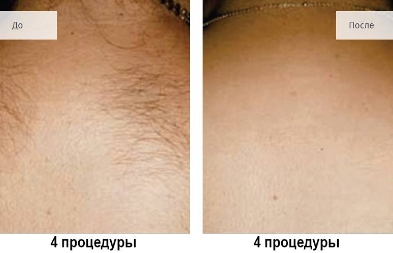 Эффектные результаты после лазерной эпиляции - фото до и после