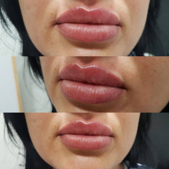 Увеличения губ гиалуроновой кислотой, что нельзя делать после процедуры