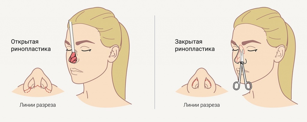 Открытая и закрытая ринопластика: в чем разница, какая лучше (плюсы и минусы), как делают