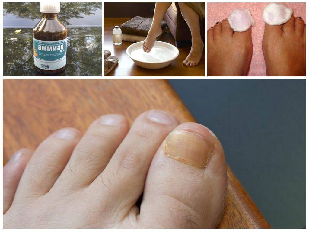 Лечение грибка ногтей на ногах народными средствами - самые эффективные рецепты и отзывы