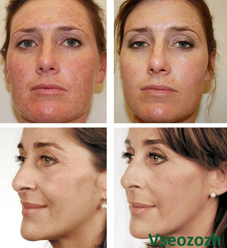 Аппаратная биоревитализация кожи лица