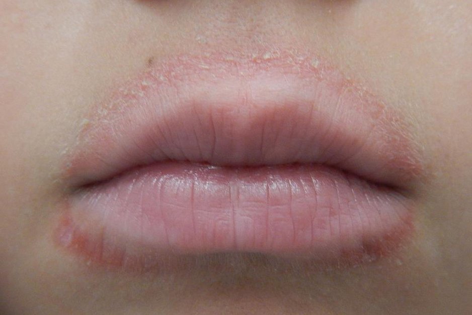 Как убрать мимические морщины вокруг губ? | блог expert clinics