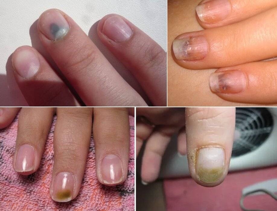 5 причин почему болят ногти после гель лака