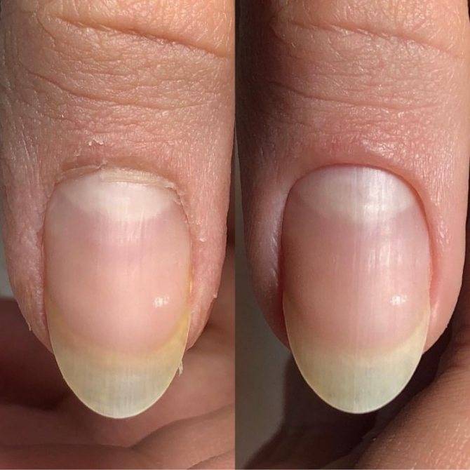 Как восстановить структуру ногтей после ее изменения? | красивые ногти - дополнение твоего образа