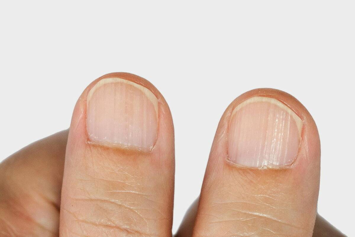 Отслаивается ноготь на руке: возможные причины, особенности ногтевой пластины, способы лечения, полезные советы от специалистов